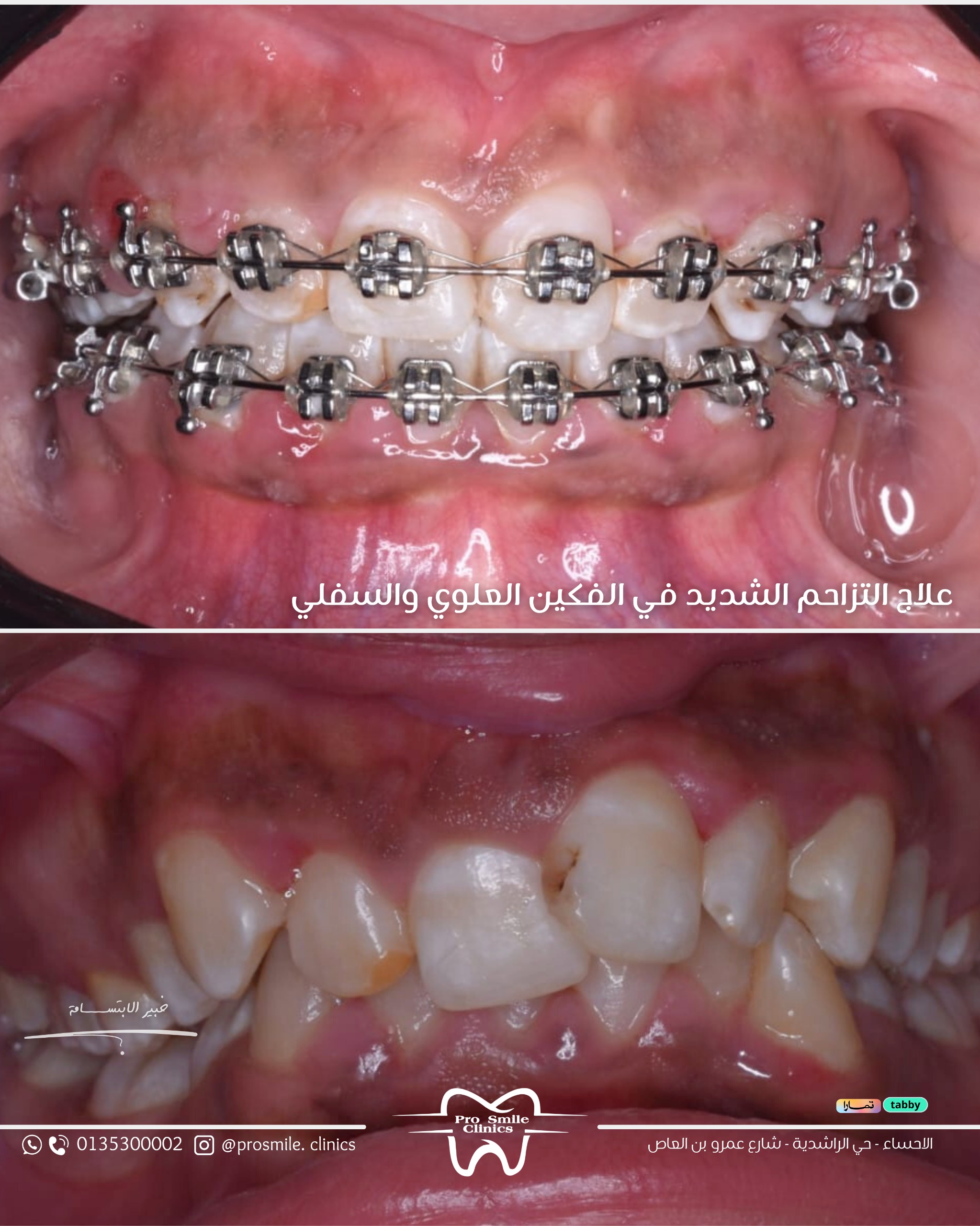 before after 6